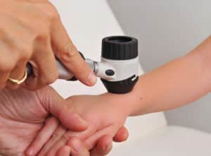 Scabies Krätze Diagnose Dermatoskop